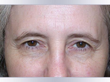 brow ptosis